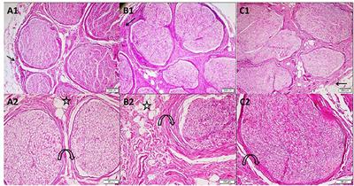 The Myth of Median Nerve in Forearm and Its Role in Double Crush Syndrome: A Cadaveric Study